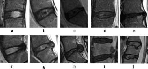 Series of mid-sagittal T2-weighted MRI images of lumbar discs showing progressive stages of disc degeneration.