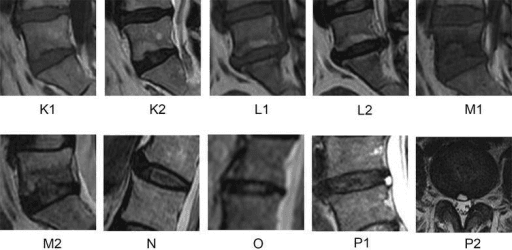 Four MRI panels of lumbar spine comparing Modic type I and type II endplate changes on T1- and T2-weighted images.