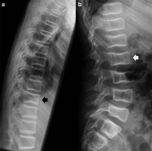 Lateral thoracic spine radiograph of an adolescent with vertebral deformity, annotated for scoring.
