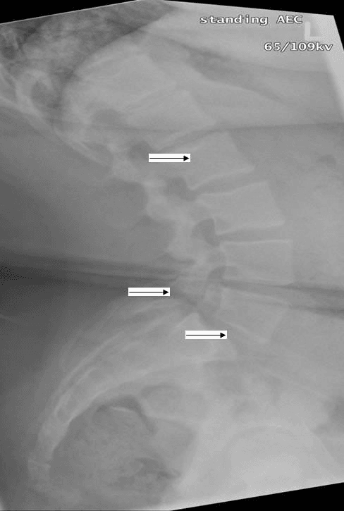 Lateral radiograph of lumbosacral spine with arrows marking bilateral pars defects and forward slip of the vertebra.