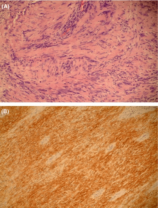 Histology of schwannoma showing Antoni A palisading and S100 immunostaining.