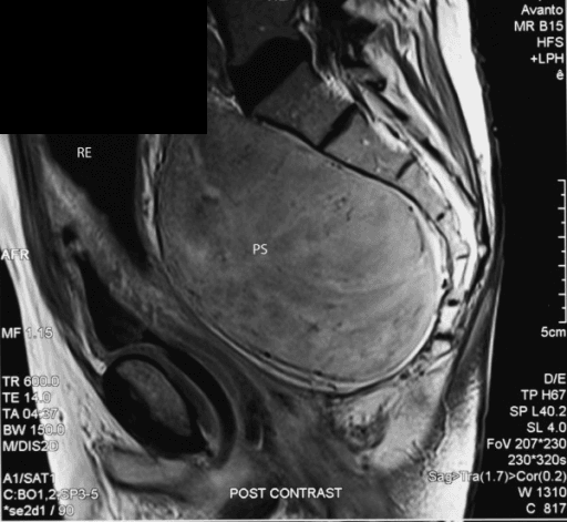 Presacral schwannoma on sagittal MRI