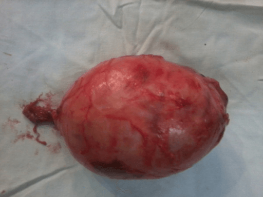 Gross surgical specimen of resected schwannoma
