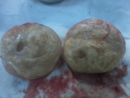 Cut section of schwannoma showing internal appearance