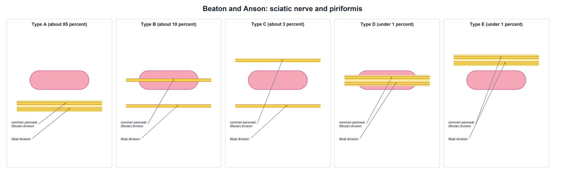 Five-panel schematic of the Beaton and Anson classification of the sciatic nerve relative to piriformis: Type A undivided below, Type B common peroneal through, Type C common peroneal above, Type D whole nerve through, Type E whole nerve above.