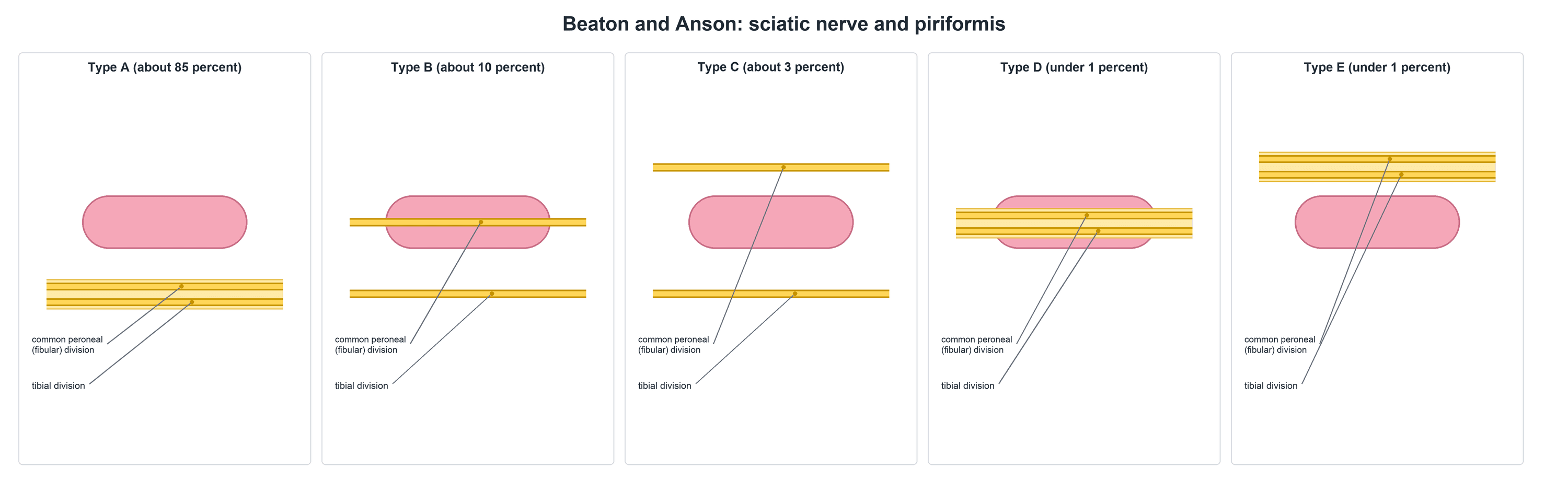 Five-panel schematic of the Beaton and Anson classification of the sciatic nerve relative to piriformis: Type A undivided below, Type B common peroneal through, Type C common peroneal above, Type D whole nerve through, Type E whole nerve above.