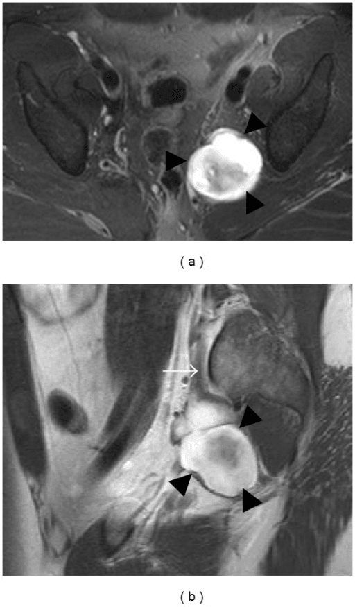 Two-panel MRI: axial T2 fat-saturated scan (a) and sagittal T1 post-contrast scan (b) of a lobulated enhancing sciatic nerve neurofibroma.