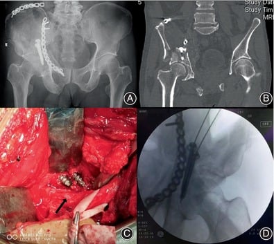 Radiograph, CT, operative and postoperative images showing acetabular screws protruding posteriorly into and injuring the sciatic nerve.