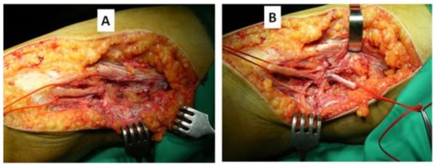 Two operative photographs showing fibrosis around the common fibular division before and after external neurolysis.