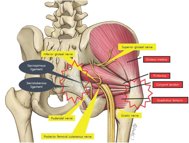 Posterior anatomical diagram of the deep gluteal space showing the sciatic nerve below piriformis and its relations to the short external rotators, ligaments and gluteal nerves.