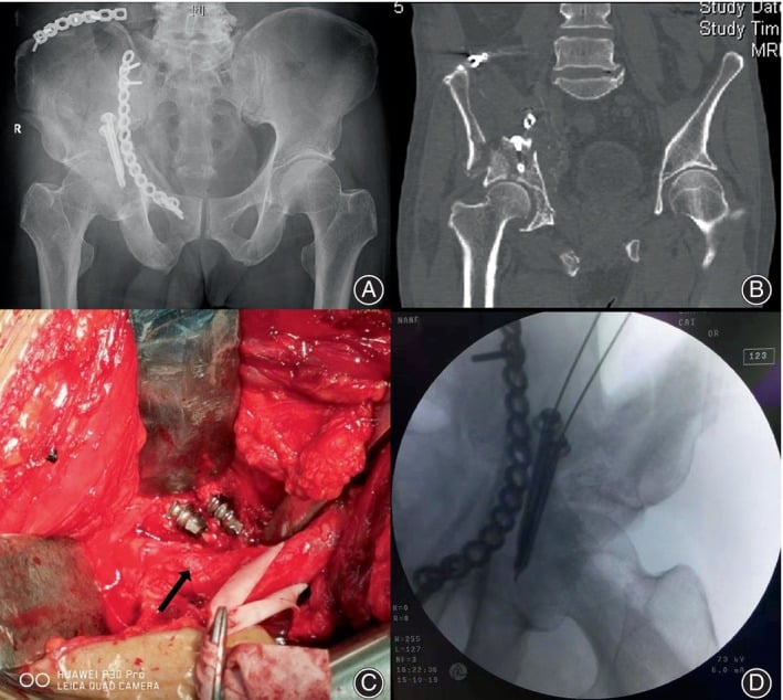 Radiograph, CT and operative images showing a malpositioned posterior acetabular implant piercing and compressing the sciatic nerve.