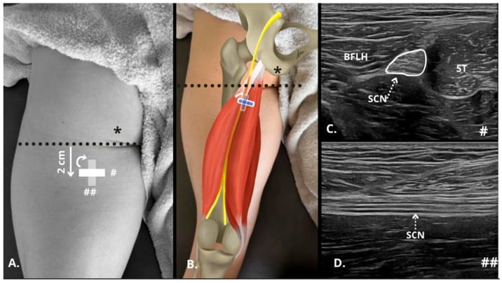 Four-panel guide to sciatic nerve ultrasound in the proximal posterior thigh showing probe positions and short-axis and long-axis nerve views.