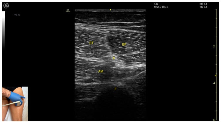 Labelled transverse ultrasound of the posterior thigh showing the sciatic nerve between biceps femoris, semitendinosus and adductor magnus.