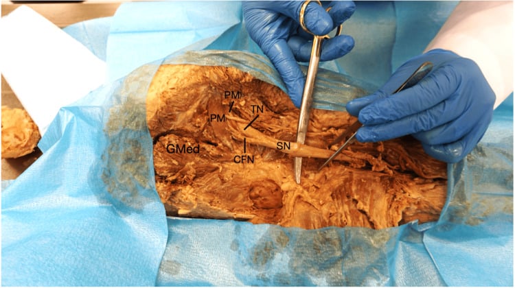 Cadaveric posterior gluteal dissection showing the common fibular division piercing a split piriformis while the tibial division passes inferiorly.