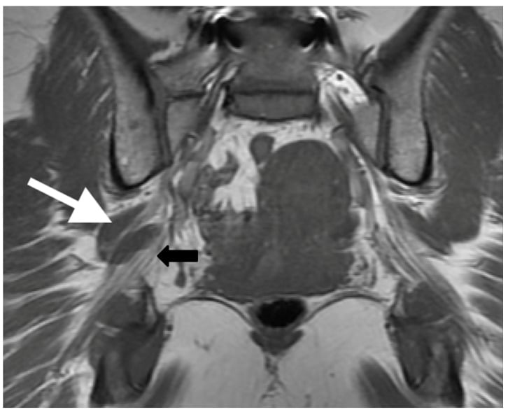 Coronal T1 magnetic resonance neurography showing the common fibular and tibial components of a split sciatic nerve around piriformis.