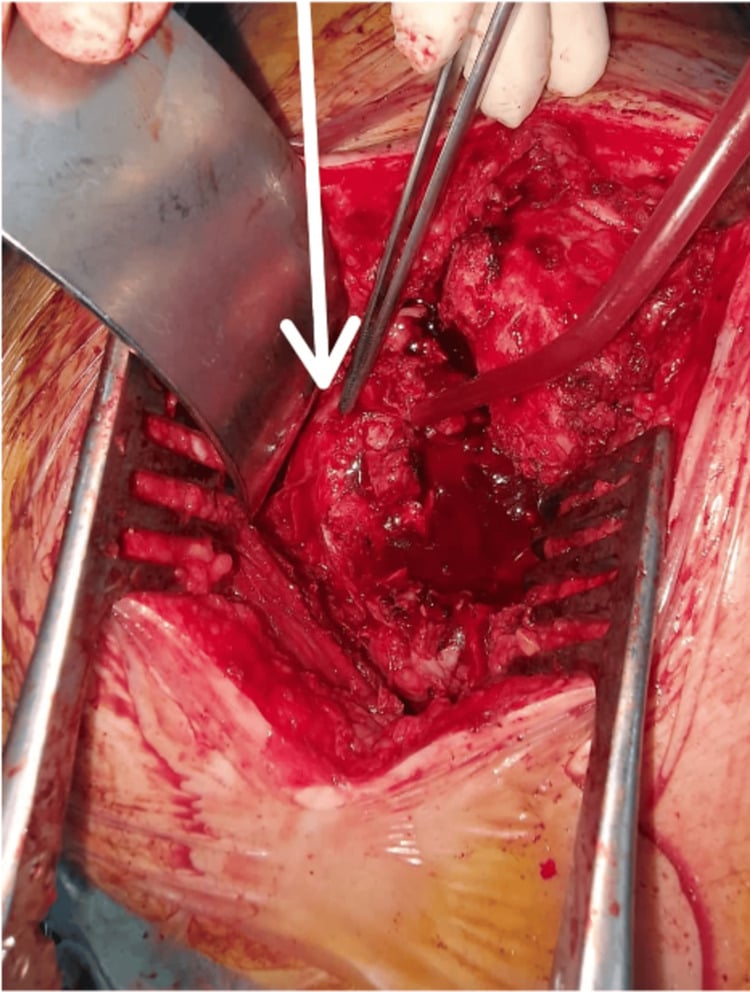 Tightly framed posterior hip operative field showing an atypically coursing sciatic nerve within dense scar and heterotopic ossification.