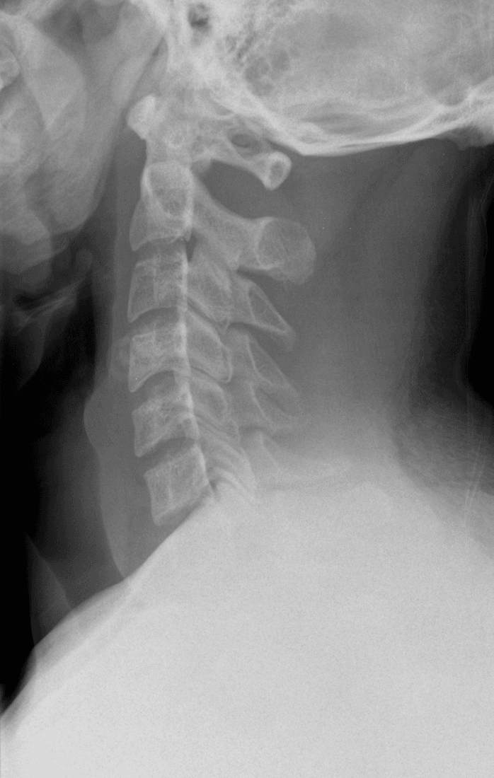 Normal lateral cervical spine radiograph