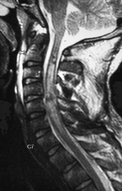 Sagittal cervical T2 MRI in SCIWORA showing cord signal change (oedema) with preserved bony alignment.