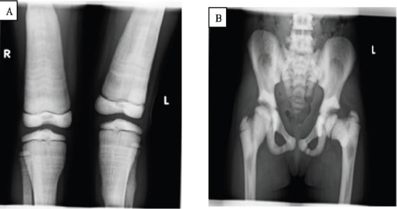 Radiographs of osteopetrosis showing Erlenmeyer flask metaphyseal widening in the knees and bone-in-bone appearance with rugger-jersey spine in the pelvis