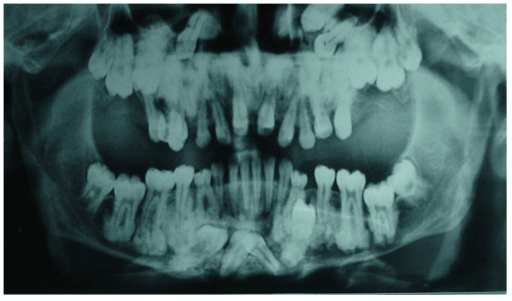 Panoramic radiograph showing multiple bilateral lobulated radiopaque jaw lesions in florid cemento-osseous dysplasia.