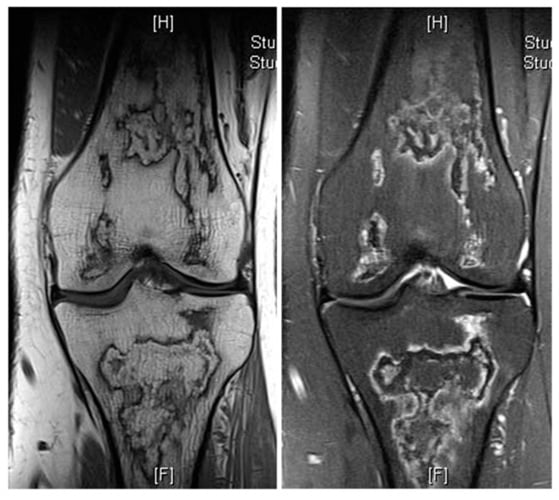Coronal knee MRI showing a serpiginous peripheral low-signal rim with preserved central marrow fat in a bone infarct.