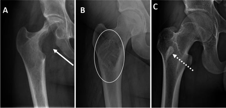 Proximal-femur radiographs comparing a sclerotic bone island with lucent and mixed lesions.