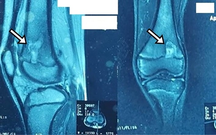 Contrast-enhanced sagittal and coronal MRI showing the penumbra sign around a Brodie abscess.