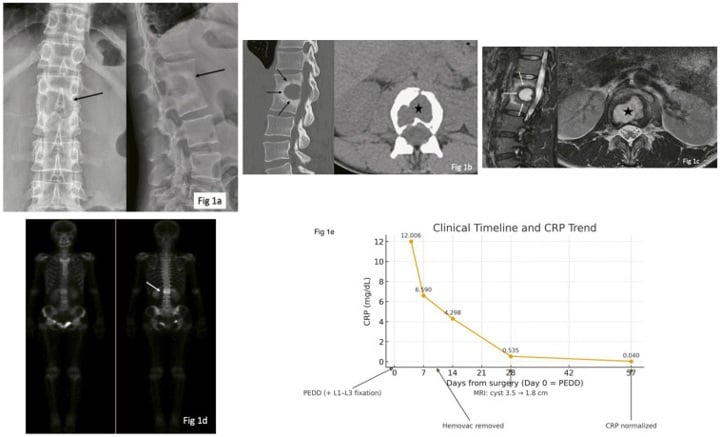 Radiograph, CT and MRI showing a vertebral Brodie abscess cavity with a peripheral sclerotic rim and fluid.