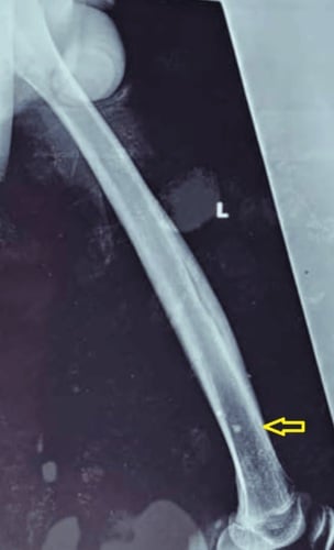 Femoral radiograph showing diaphyseal cortical thickening, sclerosis and an intracortical cloaca in chronic osteomyelitis.