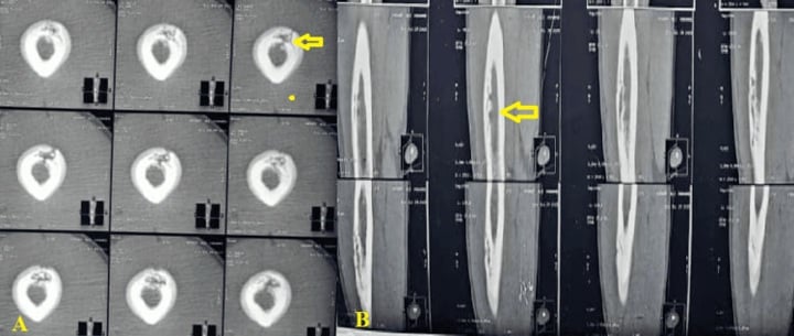 Coronal and axial femoral CT showing a dense sequestrum, cloaca, periosteal new bone and involucrum.