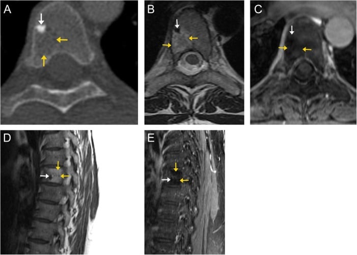 CT and MRI showing a dense non-enhancing vertebral enostosis with cortical-bone signal.