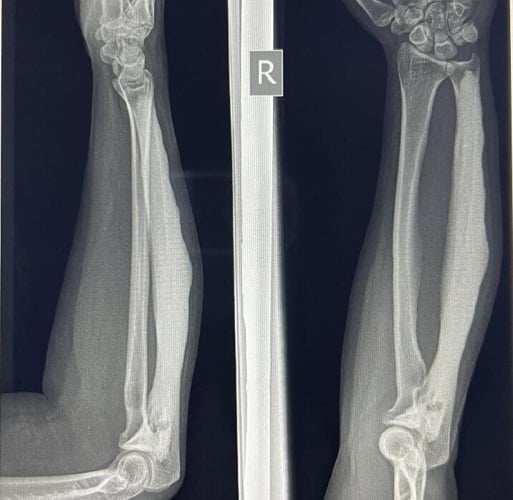 Forearm radiographs showing flowing cortical hyperostosis and radial bowing from melorheostosis.