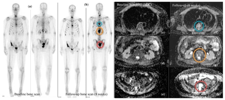 Baseline and follow-up bone scans with paired whole-body MRI response images in metastatic prostate cancer.