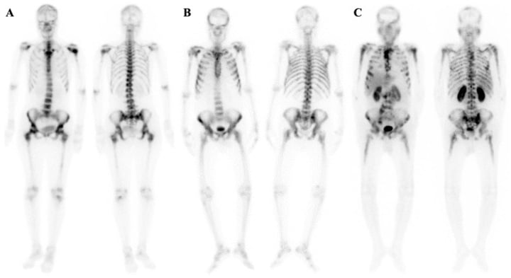 Whole-body bone scintigraphy and PSMA SPECT-CT showing metastatic superscan patterns in breast and prostate cancer.