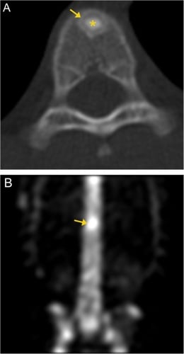 Axial CT and bone scintigraphy showing an osteoid osteoma nidus with intense focal uptake.