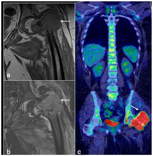 Coronal MRI and PET-CT showing a metabolically active proximal-femoral osteosarcoma.