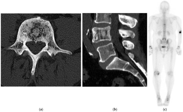 Multimodal images showing Paget disease with vertebral cortical and trabecular thickening and increased bone-scan uptake.