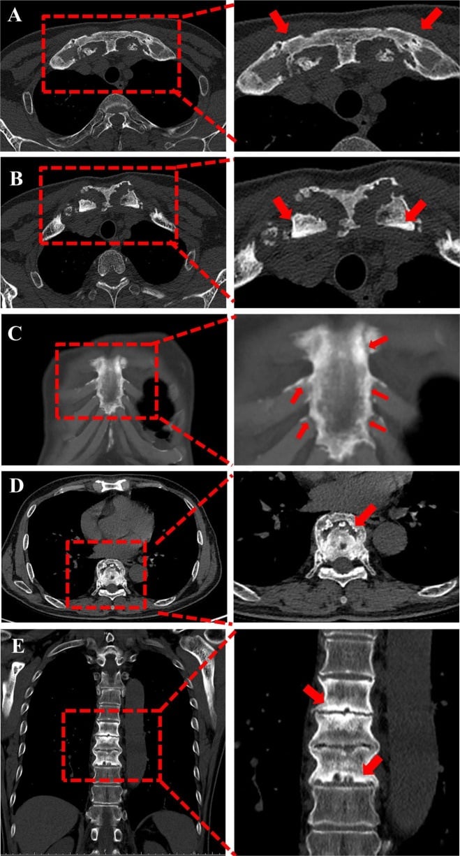 CT images showing sternocostoclavicular sclerosis, hyperostosis and associated spinal lesions in SAPHO syndrome.