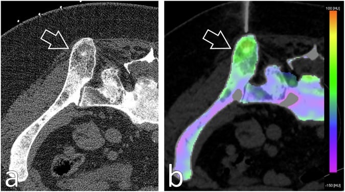 PET-CT and photon-counting CT images showing image-guided biopsy of a heterogeneous sclerotic iliac lesion.