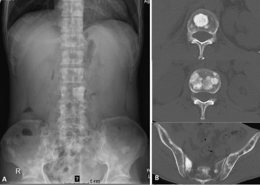 Radiograph and CT showing multiple plaque-like sclerotic lesions in the spine and pelvis in POEMS syndrome.