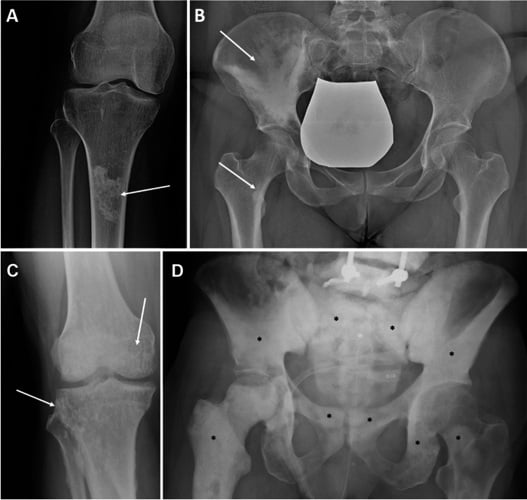 Radiographs showing bone infarct, melorheostosis, osteopoikilosis and prostate-cancer metastases as distinct sclerotic patterns.