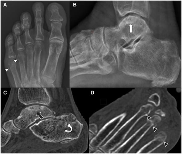 Foot and ankle radiographs and CT showing stress fractures with focal sclerosis.