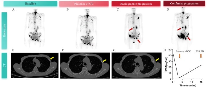 Serial bone scans and CT showing evolving osteosclerotic change during treatment of prostate-cancer bone metastases.