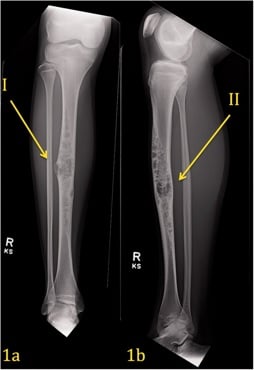 AP and lateral tibial radiographs showing a multiloculated soap-bubble adamantinoma