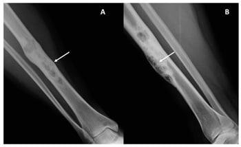 AP and lateral radiographs showing a geographic soap-bubble adamantinoma of the tibial diaphysis