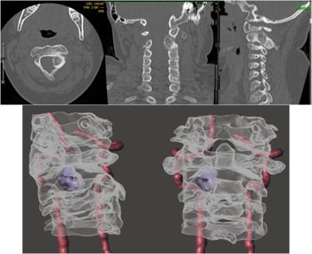 Multiplanar CT and three-dimensional angiography showing a C2 osteoid osteoma beside vascular structures