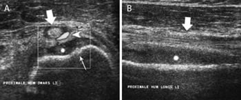 Transverse and longitudinal ultrasound showing cortical penetration and subperiosteal pus in childhood osteomyelitis