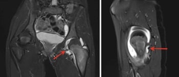 Coronal and sagittal MRI showing extensive oedema around a femoral-neck osteoid osteoma