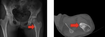 Pelvic radiograph and axial CT showing an intra-articular femoral-neck osteoid osteoma