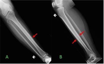 AP and lateral tibial radiographs showing diffuse cortical thickening in Garré osteomyelitis